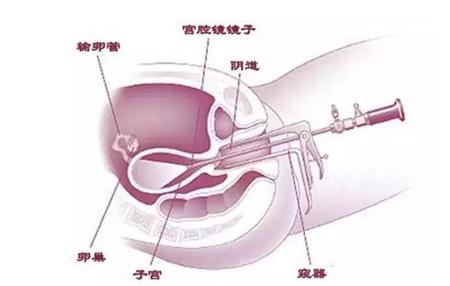 宫腔镜检查适应症