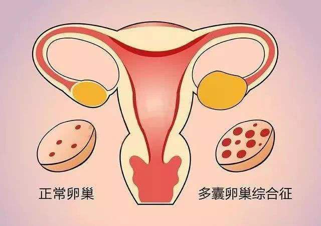 多囊姐妹备孕攻略（7大快速怀孕的绝招）